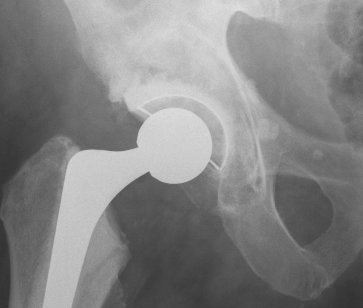 Revision THR Impaction Bone Graft Acetabulum